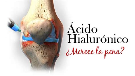 Acido hialuronico rodilla PenalbaWeb.com