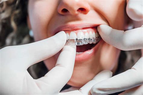Aparato dental invisible PenalbaWeb.com