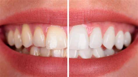 Blanqueamiento de dientes PenalbaWeb.com