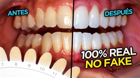 Blanquear dientes en casa PenalbaWeb.com