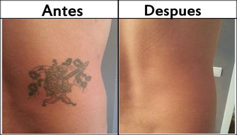 Borrar tatuajes PenalbaWeb.com