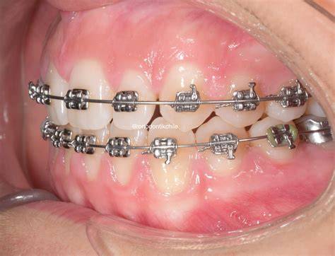 Brackets metalicos PenalbaWeb.com