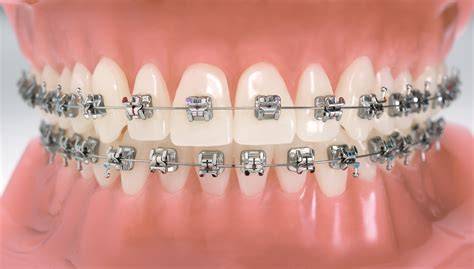 Brackets PenalbaWeb.com