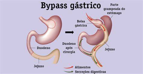 Bypass gastrico PenalbaWeb.com