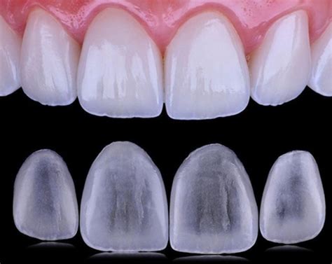 Carillas dentales PenalbaWeb.com