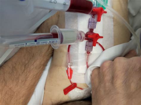 Cateter PenalbaWeb.com