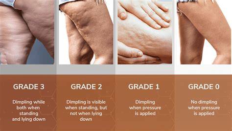 Cellulite PenalbaWeb.com