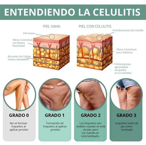 Celulitis PenalbaWeb.com