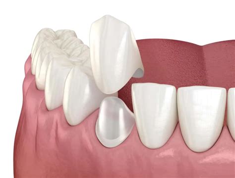 Corona dental PenalbaWeb.com
