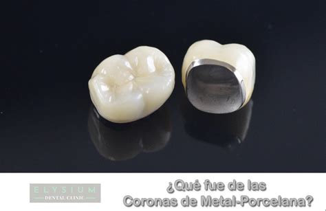 Corona metal porcelana PenalbaWeb.com