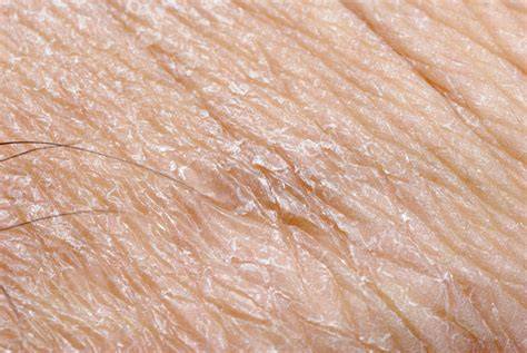 Dry skin PenalbaWeb.com