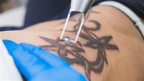 Eliminar tatuajes PenalbaWeb.com