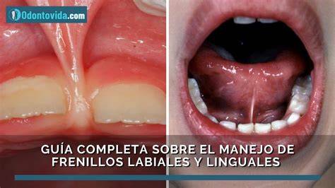 Frenillos PenalbaWeb.com