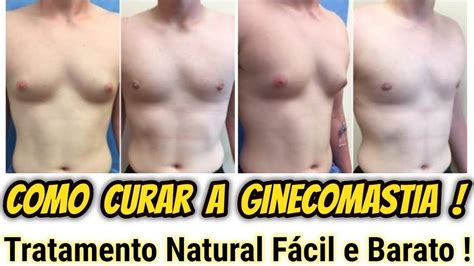 Ginecomastia PenalbaWeb.com