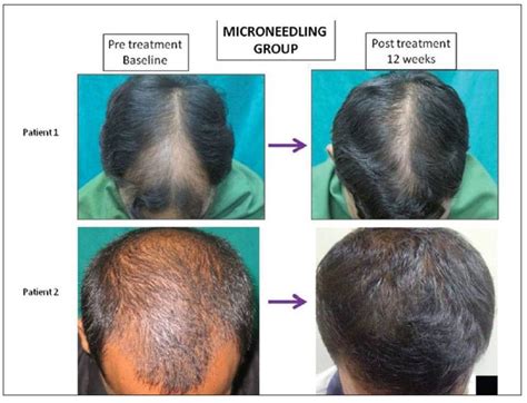 Hair loss treatment PenalbaWeb.com