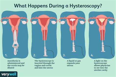 Hysteroscopy PenalbaWeb.com