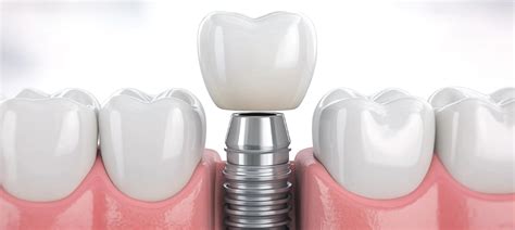 Implante dental PenalbaWeb.com