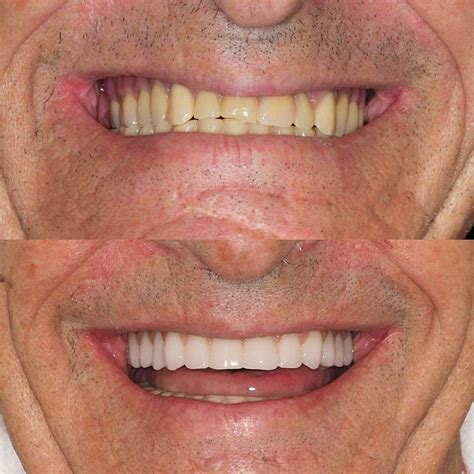 Implantes dentales fijos PenalbaWeb.com