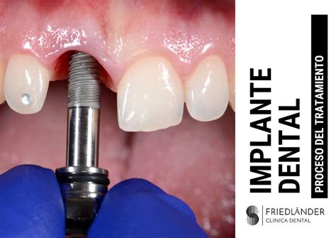 Implantes dentales PenalbaWeb.com