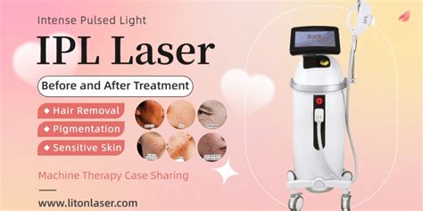 Laser ipl PenalbaWeb.com