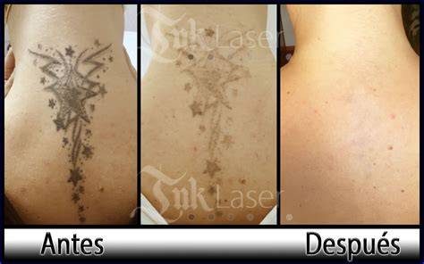 Laser quitar tatuajes PenalbaWeb.com