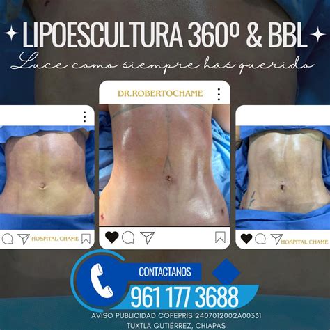 Lipoescultura PenalbaWeb.com