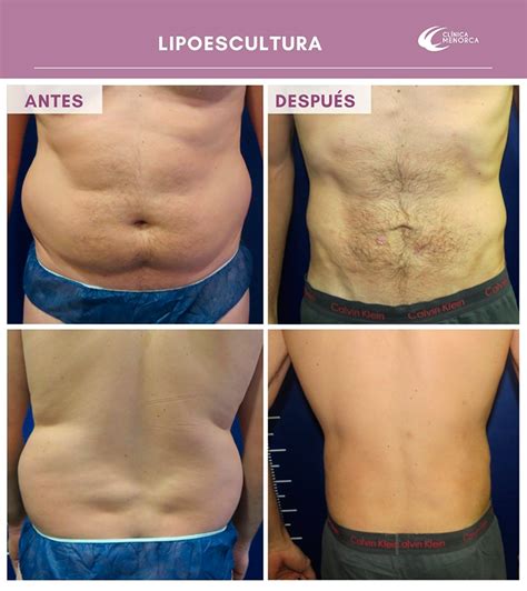 Liposuccion de abdomen PenalbaWeb.com
