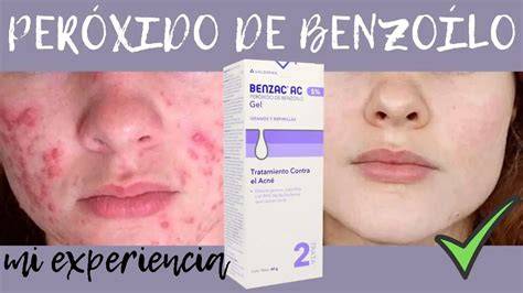 Peroxido de benzoilo PenalbaWeb.com
