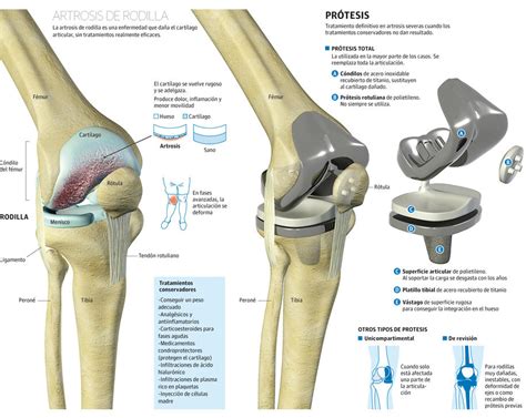 Protesis rodilla PenalbaWeb.com