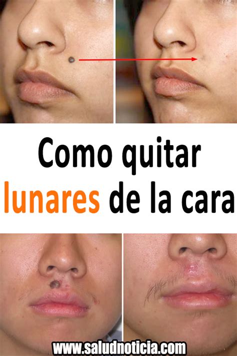 Quitar lunares PenalbaWeb.com