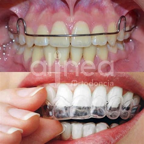 Retenedor ortodoncia PenalbaWeb.com
