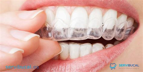 Retenedores dentales PenalbaWeb.com