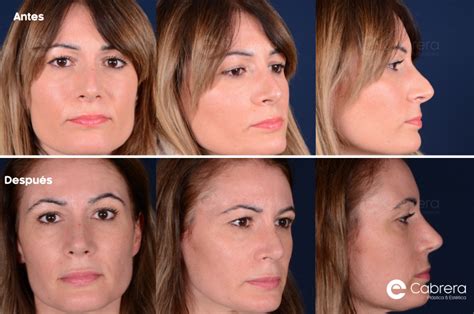 Rinoplastia PenalbaWeb.com