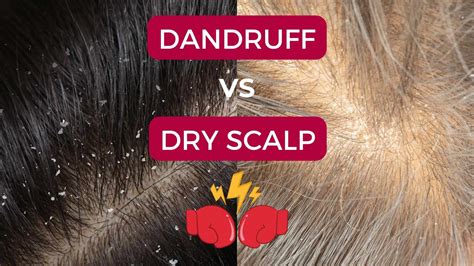 Scalp dandruff PenalbaWeb.com