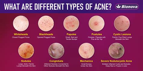 Skin acne PenalbaWeb.com