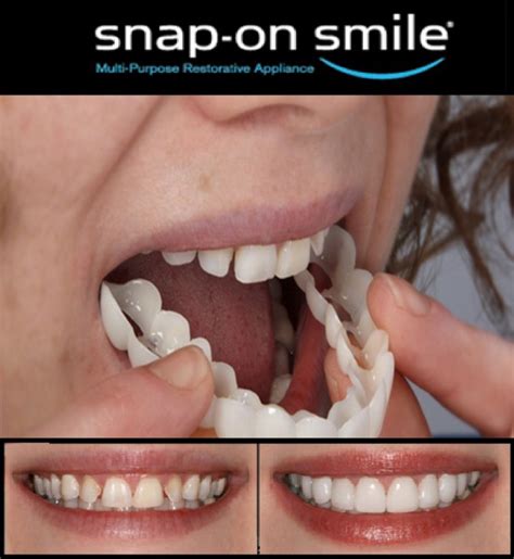 Snap on smile PenalbaWeb.com