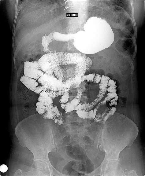 Transito intestinal PenalbaWeb.com