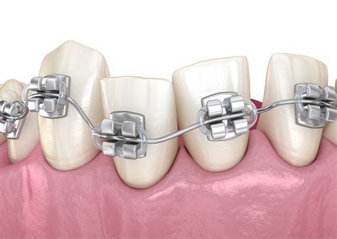 Tratamiento ortodoncia PenalbaWeb.com
