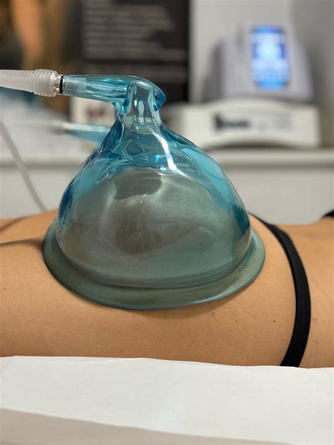 Vacumterapia PenalbaWeb.com